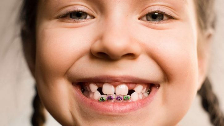 Çocuklarda Diş Teli (Ortodonti) Tedavisi