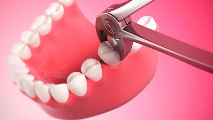 Diş Çekimi Hangi Durumlarda ve Nasıl Yapılır?