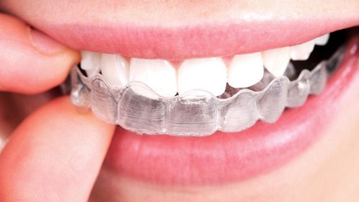 Telsiz Ortodonti Tedavisi Nedir, Nasıl Yapılır?