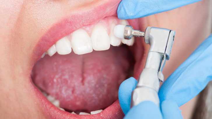 Diş Taşı Temizleme ve Faydaları