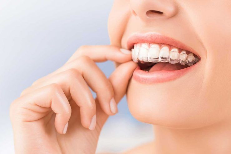 Invisalign – Şeffaf Plak Tedavisi